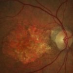 degeneración macular asociada a la edad