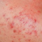 dermatitis atópica