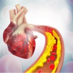 El control de la hipertrigliceridemia es clave en el manejo del riesgo cardiovascular