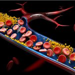 Acumulación de colesterol en las arterias, marca el riesgo cardiovascular