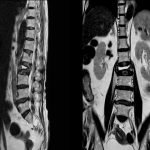 fracturas vertebrales por osteoporosis