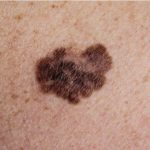 melanoma