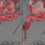 Nueva herramienta Azurion permite diagnosticar lesiones neurológicas rápidamente