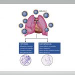 estudio metoprolol en pacientes COVID-19 graves