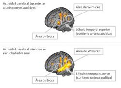 alucinaciones-auditivas