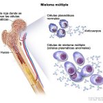 Pacientes y especialistas piden implementar acciones para atender el mieloma múltiple