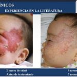 hemangioma infantil padecimiento