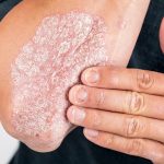 El sobrepeso supone un déficit de respuesta al tratamiento en muchos pacientes con psoriasis