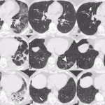 Daños pulmonares persisten tras la COVID-19