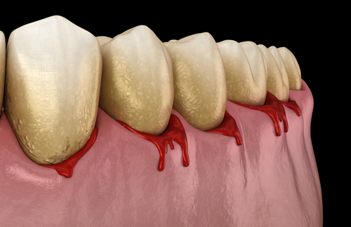 periodontitis