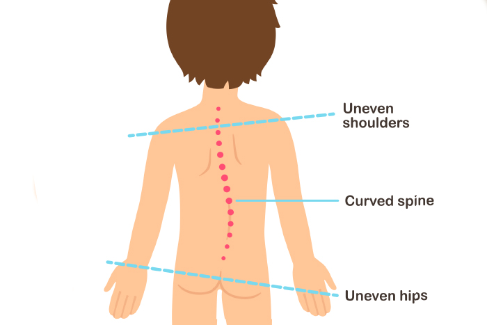 escoliosis infantil