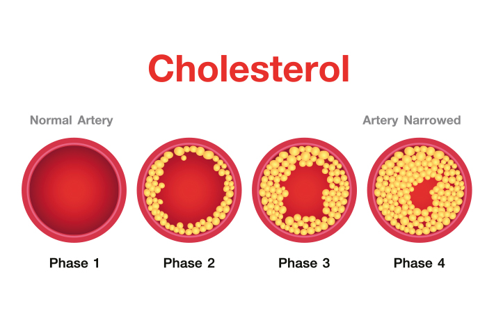 colesterol arterias