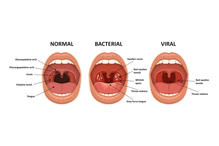 faringitis-bacteriana-viral