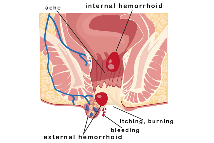 hemorroide