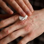 La psoriasis en México y cómo se presenta