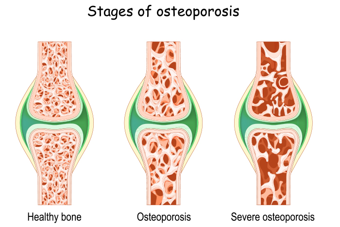 osteoporosis