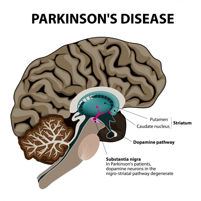 parkinson