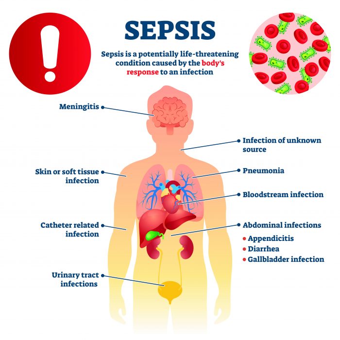 sepsis