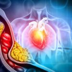 Combinar estatinas y ezetimiba consigue alcanzar objetivos en alto riesgo cardiovascular