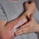 Nuevo tratamiento para combatir la dermatitis atópica y asma infantil