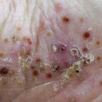 La Psoriasis Pustulosa Generalizada se caracteriza por pústulas dolorosas no contagiosas por todo el cuerpo.