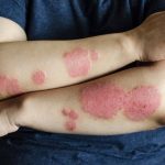 nuevo tratamiento biológico en México para psoriasis en placa