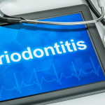 Periodontitis moderada a avanzada aumenta riesgo de infarto agudo de miocardio