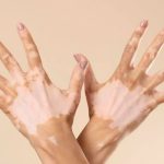 el vitiligo forma parte del grupo de padecimientos conocidos como psicodermatosis.